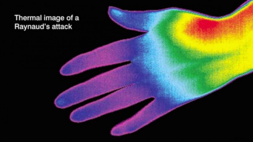 Love Your Gloves for Raynaud’s Awareness Month!
