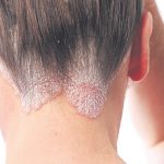 Psoriasis – what you need to know