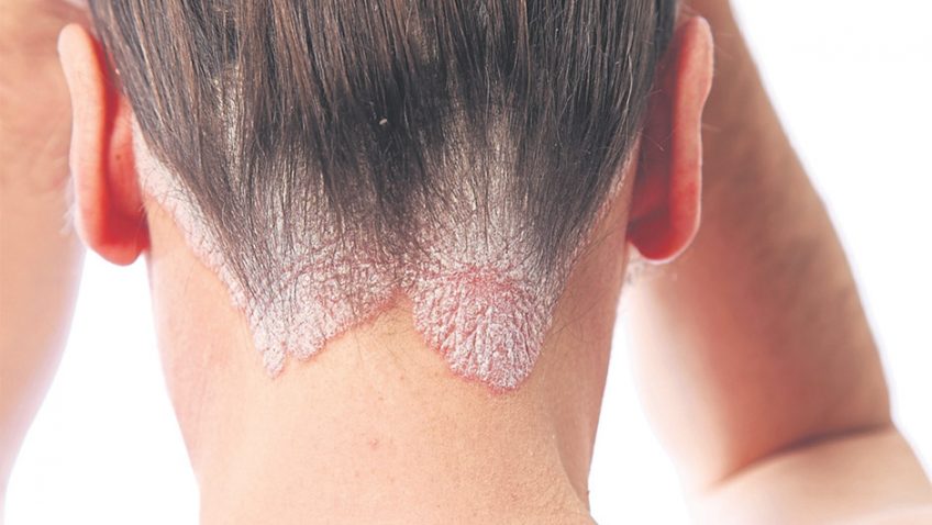 Psoriasis – what you need to know
