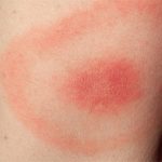 Lyme disease rash