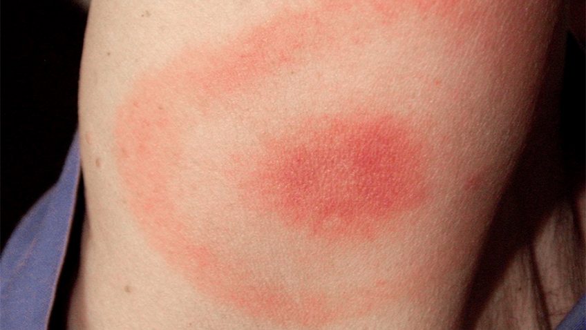 Lyme disease: know the facts, know the risks